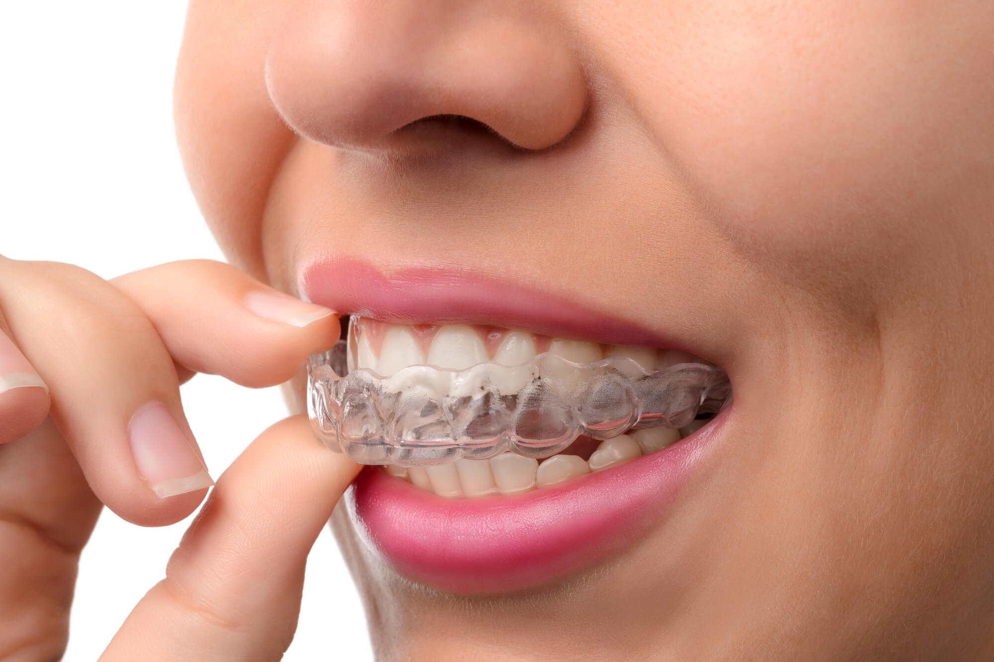 where can i get invisalign in greenville sc?