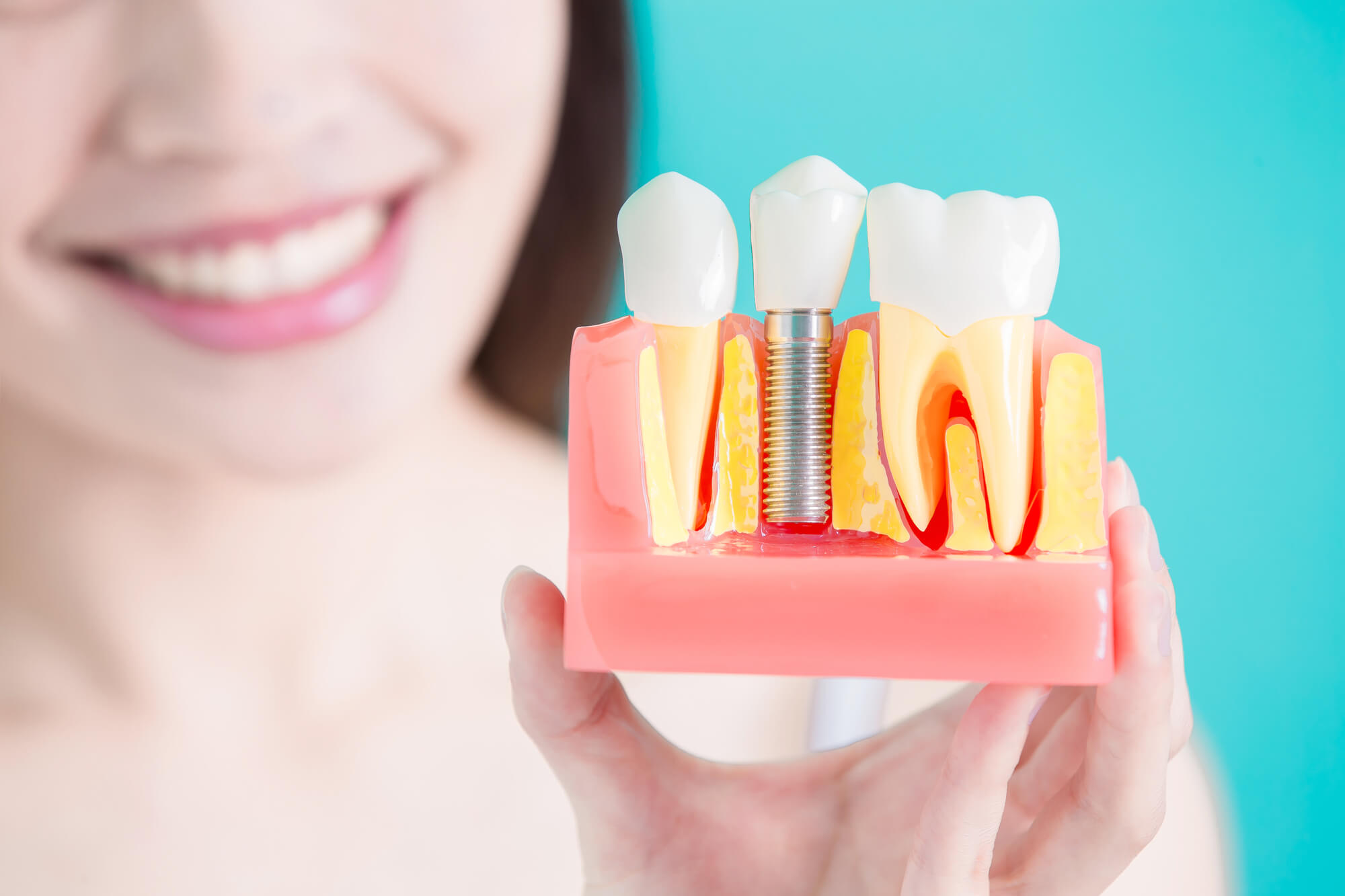 What are dental crowns Simpsonville SC?