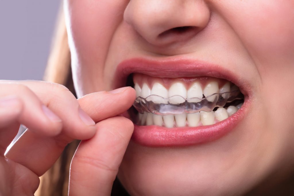 Invisalign Simpsonville SC