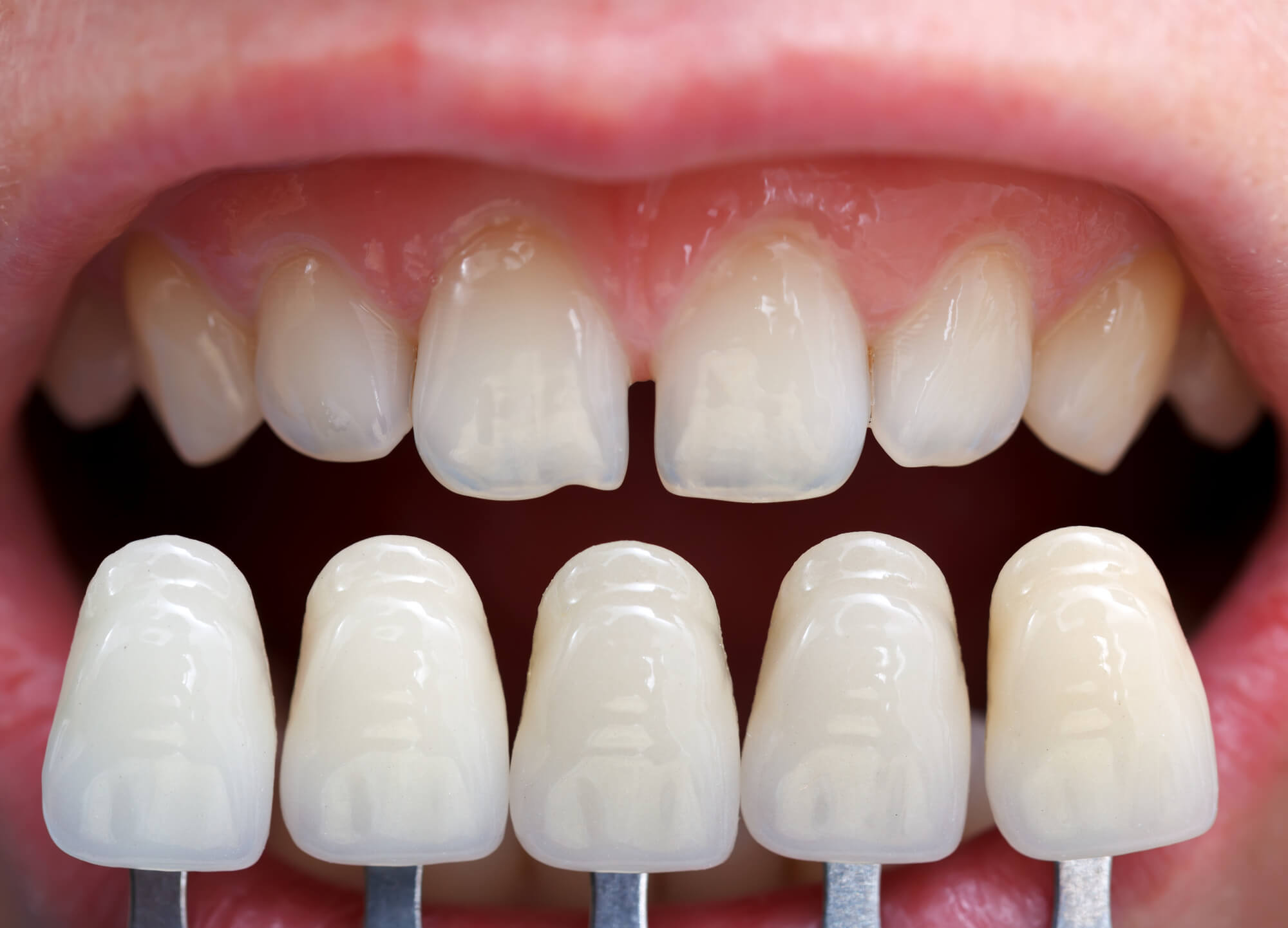 Sample of veneers in Greenville SC