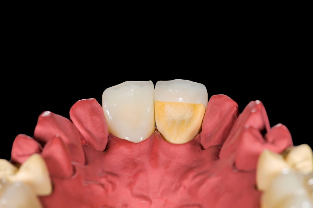 model of crowns in Greenville SC