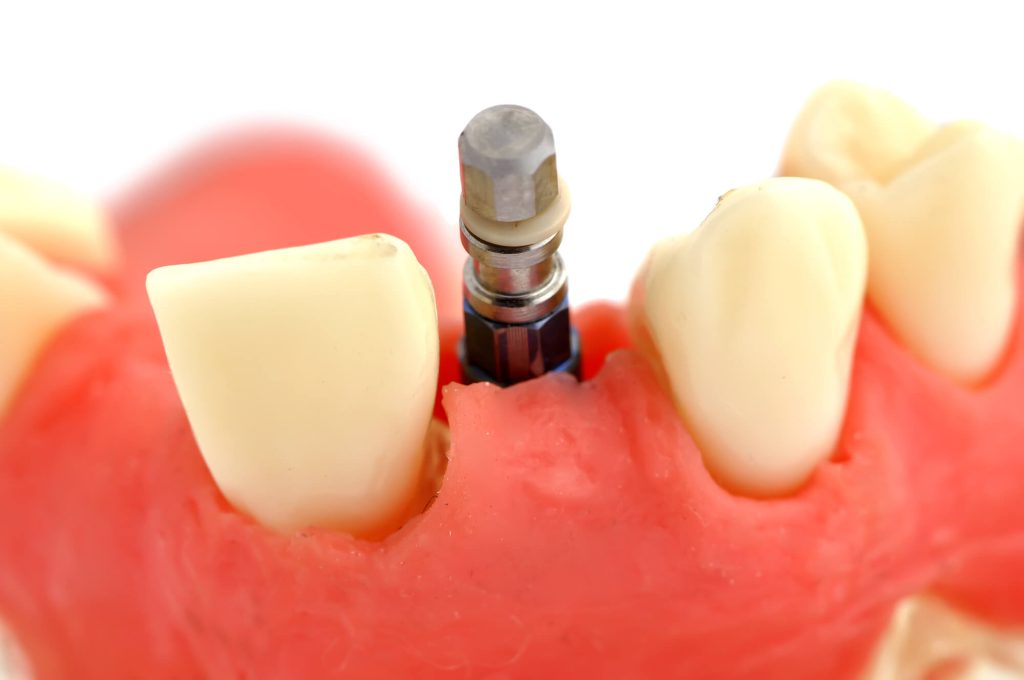 close up view of dental implants in Greenville SC