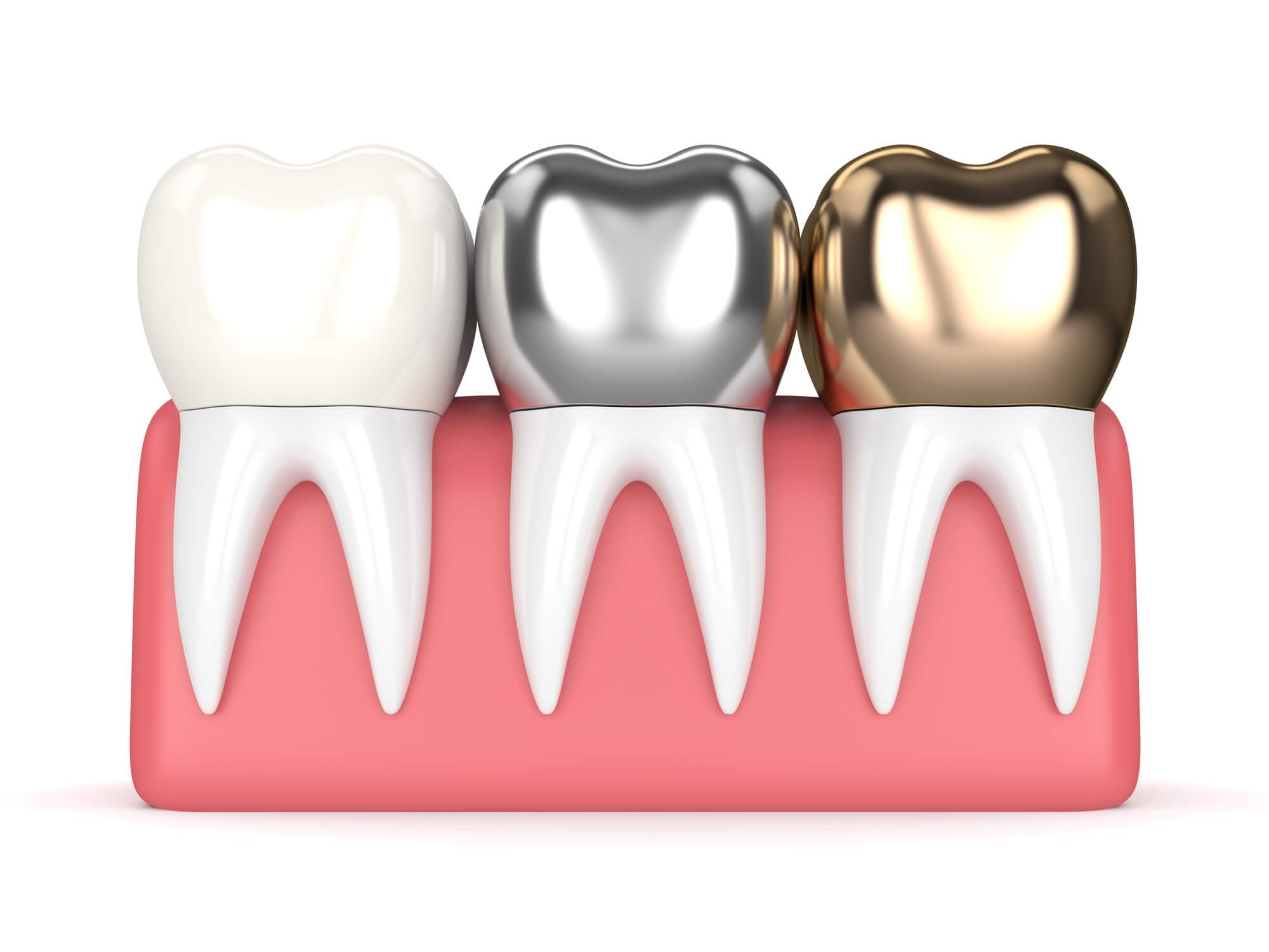illustration of dental crowns Greenville SC made of different materials