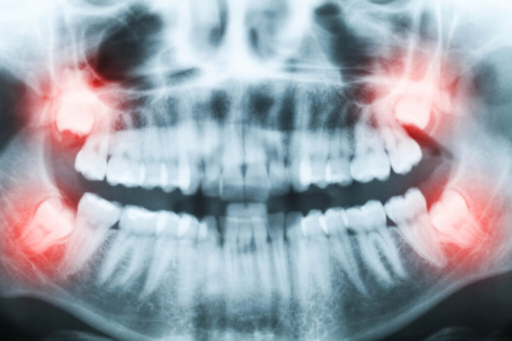 wisdom teeth in Simpsonville SC xrays