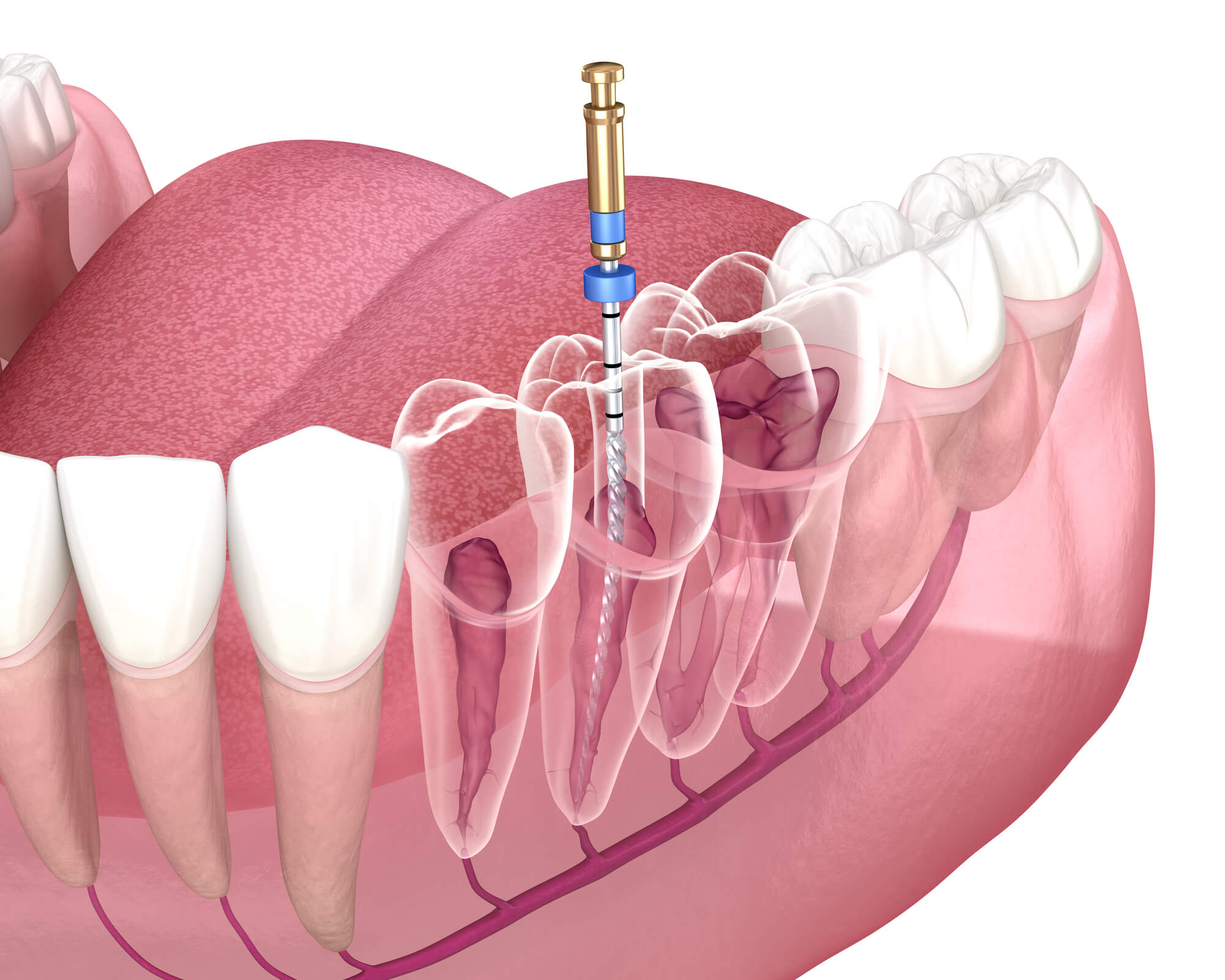 root canal Simpsonville SC illustration