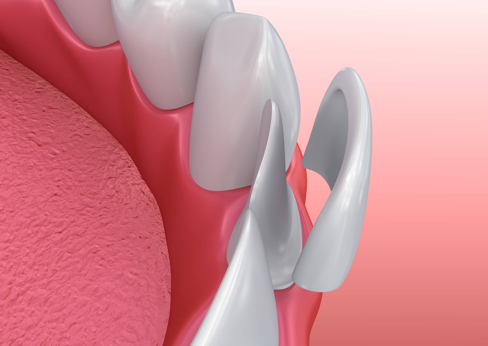 veneers in Greenville SC illustration